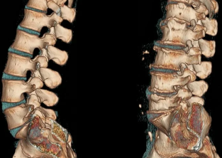 osteochondrosis
