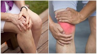 a tünetek a osteoarthritis
