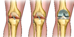 mi az arthrosis