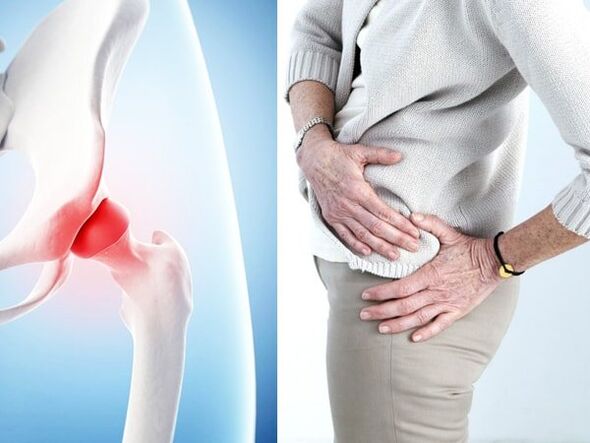 a csípőízület arthrosisának tünetei