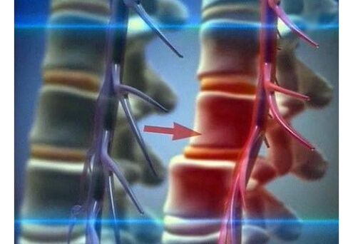 Az idegvégződések szorítása az ágyéki osteochondrosisban