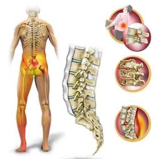 Az ágyéki gerinc osteochondrosisa, amely hátfájást okoz