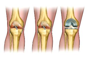 a fokú osteoarthritis
