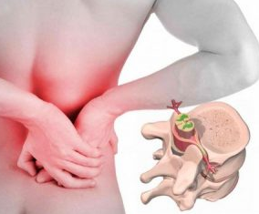 Lumbágó elején a betegség osteochondrosis