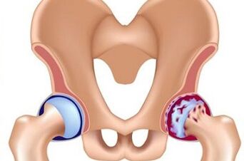 A csípőízület arthrosis fejlődésének szakaszai