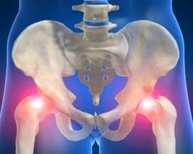 A csípőízület arthrosis okai