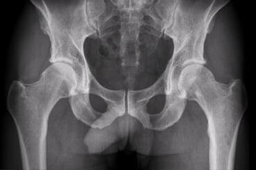 Diagnosztikai lehetőségek a csípőízület artrózisának