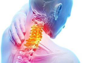 A méhnyak osteochondrosis fő jelei és tünetei