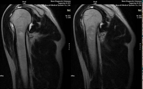 röntgen a vállízületi arthrosis diagnosztizálására