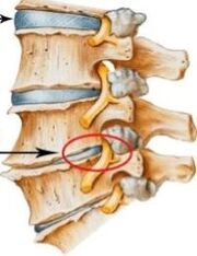 a nyaki gerinc osteochondrosisa