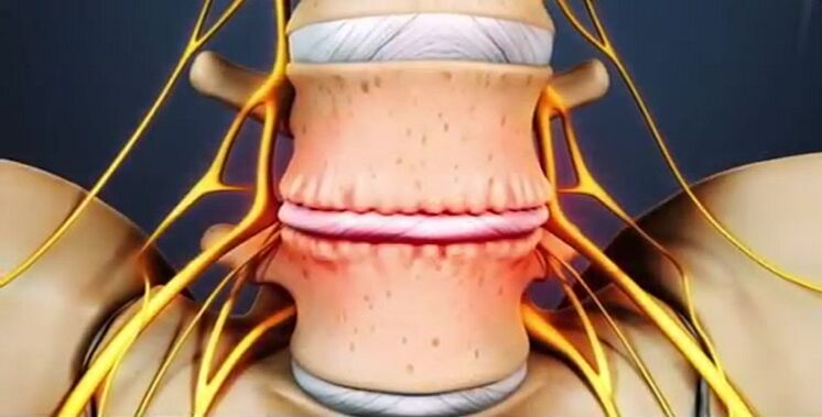 osteochondrosis okozta gerinc elváltozások